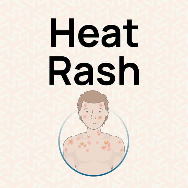 complete-guide-to-heat-rash-relief-uk-guide-hurak